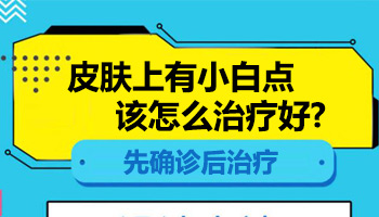 儿童下巴长白癜风擦他克莫司能治好吗