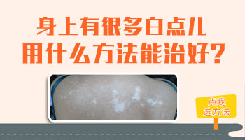 小孩身上有白块怎么治没有副作用