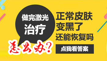 儿童腿上长白癜风只照308激光能控制住吗